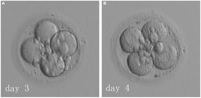 Advanced age woman with diminished ovarian reserve obtained live birth following a zero pronuclei-derived four-cell frozen-thawed embryo transfer on day 4: a case report